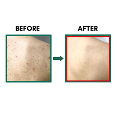 SOME BY MI AHA BHA PHA 30 Days Miracle Clear Body Cleanser (400ml) Results before and after